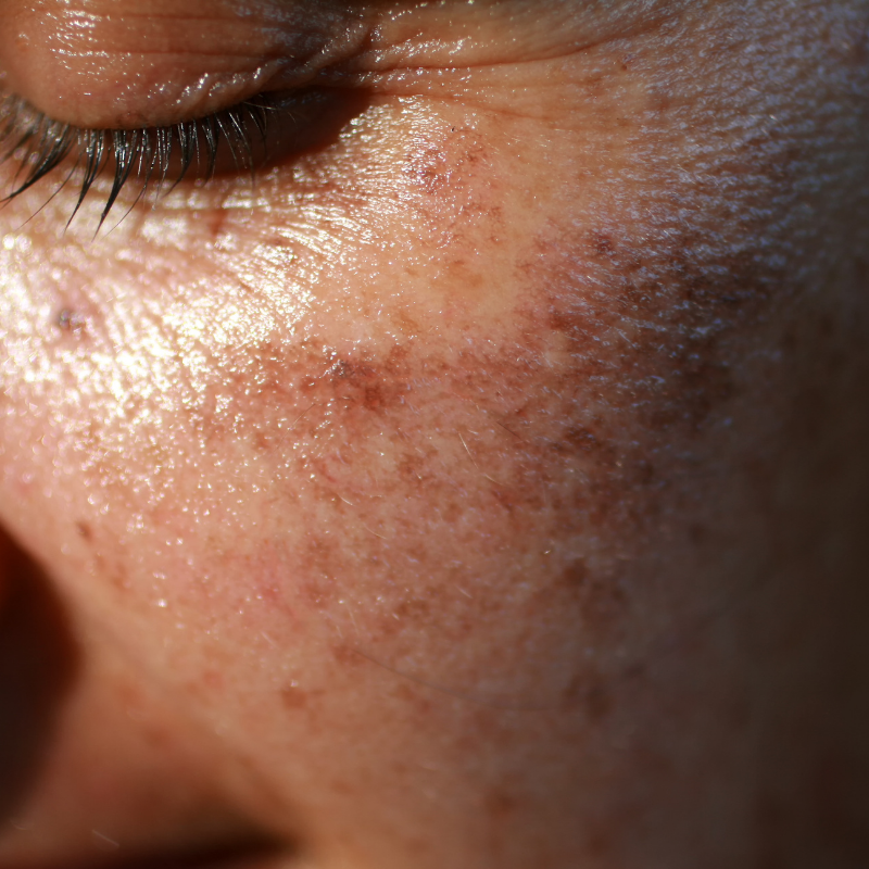 Dark Spots Treatments